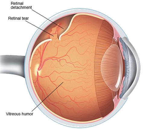 Regain Your Vision - Get Expert Care for Retinal Detachment Diagnosis from a Low Vision Optometrist